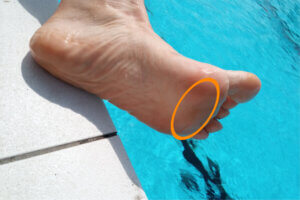 Voet met een oranje ellips op de bal van de voet die aangeeft waar de pijn zit bij metatarsalgie.